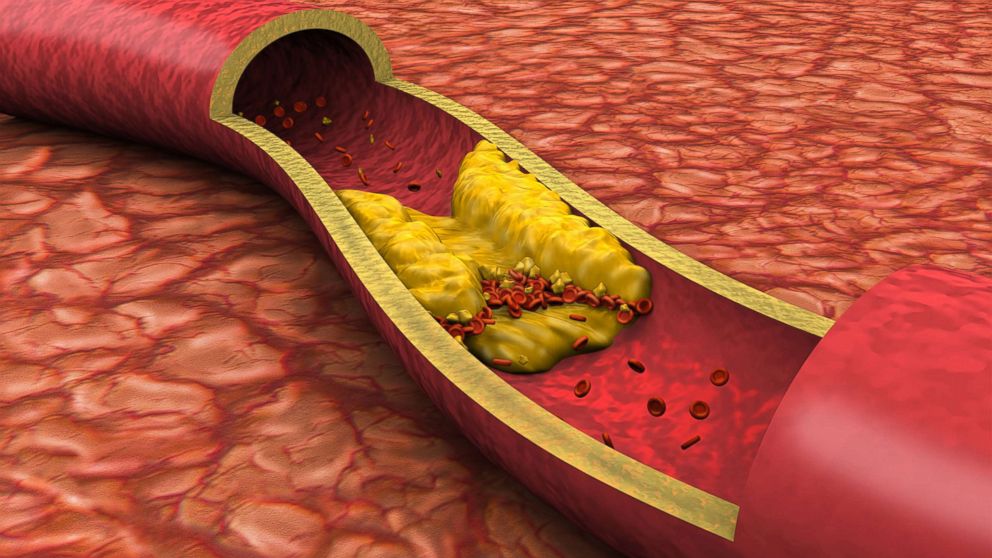 understanding-cholesterol-problems-symptoms-mundo